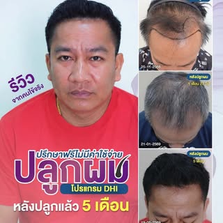 ดูแลปัญหาเส้นผมและหนังศีรษะ ด้วยการปลูกผมเทคนิค DHI
ทางเลือกสำหรับผู้ที่มีปัญหาผมบางและแนวผมถอยร่น
ด