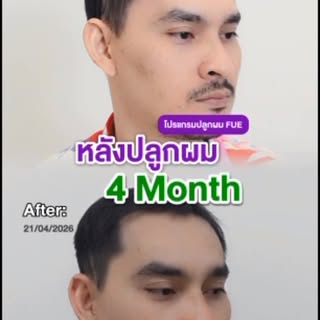 จากผมบาง สู่ผมที่เริ่มกลับมา 🌱 4 เดือนหลังปลูกผม

•นัดหมายปรึกษาแพทย์ชำนาญการเพื่อตรวจประเมินสภาพเส
