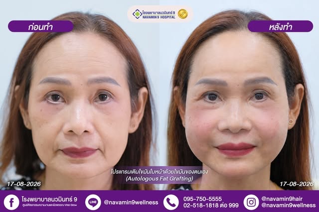 ✨ เติมเต็มมิติให้ใบหน้า ด้วยการเติมไขมันบริเวณใบหน้า

การเติมไขมันเป็นอีกทางเลือกในการปรับความสมดุลแ