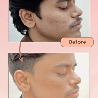 Transform your skin with the ultimate Carbon Laser Facial treatment! ✨ Say goodbye to stubborn acne,