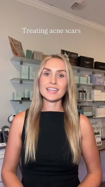 ✨ One of my FAVORITE treatments for acne scarring: microneedling!

Microneedling works by creating c