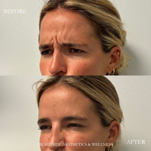 ✨ A little Botox, a smoother look.

This before & after shows the softening of the “11s” (glabellar 