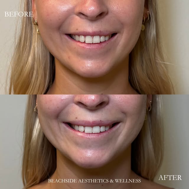 ✨ Small adjustments, beautiful balance.

This before & after focused on improving lip asymmetry, cre