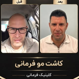 از «قبل» تا «بعد»؛ تغییر واقعی با یک انتخاب درست ✨
نتیجه‌ی کاشت مو فرمانی، با حفظ ظاهر طبیعی و طراحی