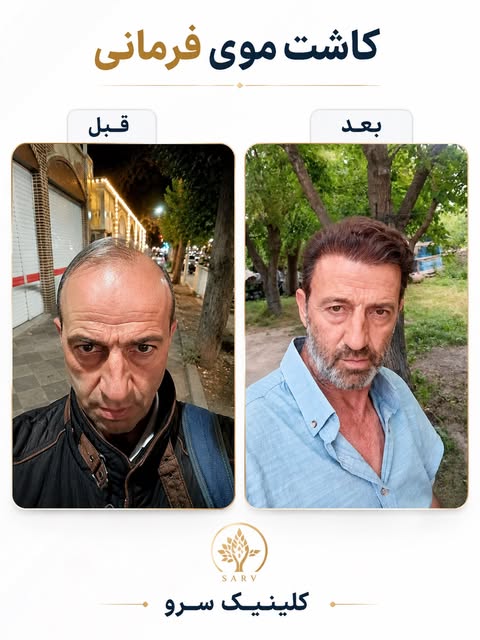 **از قبل تا بعد؛ یک تغییر واقعی ✨*
نتیجه‌ی کاشت مو فرمانی، با هدف ایجاد خط رویش طبیعی و تراکم متناسب