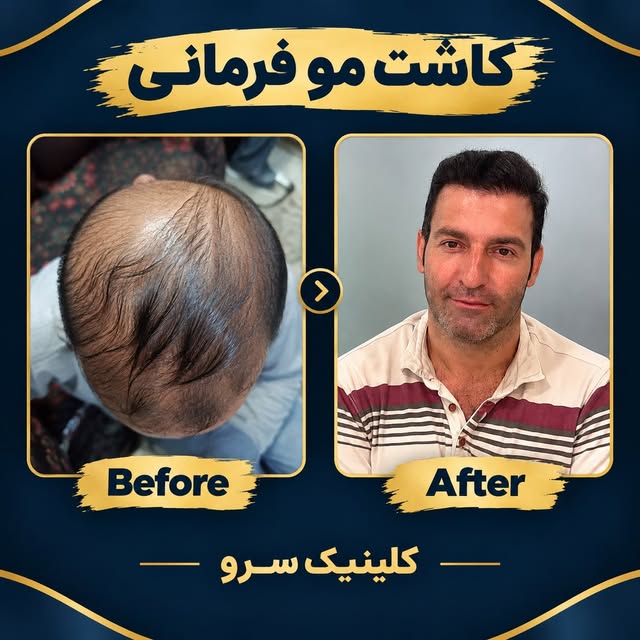 نتیجه کاشت مو فقط به تعداد گرافت‌ها وابسته نیست.

طراحی خط رویش، انتخاب ناحیه مناسب برای برداشت، جهت