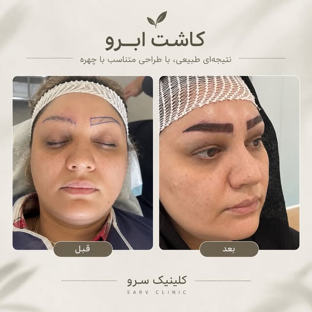 برای این پست، این کپشن شیک و حرفه‌ای مناسبه:

کاشت ابرو؛ وقتی طبیعی بودن، مهم‌ترین جزئیاته 🤍✨

در ک
