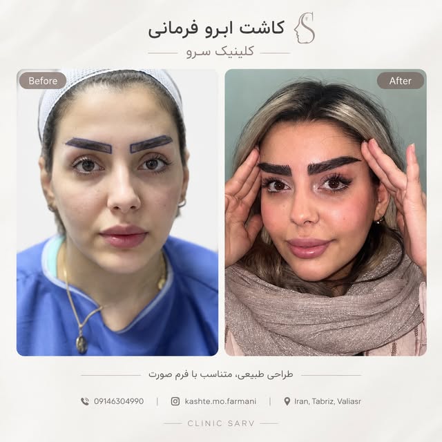 ✨ قبل و بعد از کاشت ابرو

طراحی ابرو، متناسب با فرم صورت و ویژگی‌های چهره انجام میشه تا نتیجه نهایی 