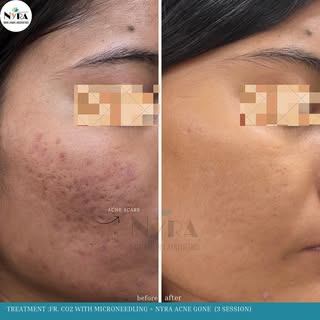 This patient had long battled the physical and emotional scars left by severe acne. Despite trying v