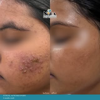 ✨ From stubborn bumps to healthier, clearer skin.

Not every breakout is acne.

Sometimes, those tin