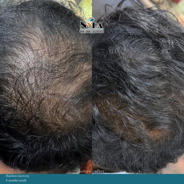 Hair growth doesn’t happen overnight—but with the right diagnosis, consistent treatment, and a littl