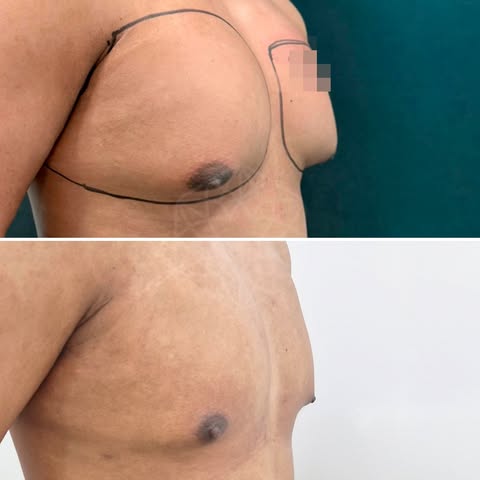 👉Tenía Ginecomastia con grasa localizada en el pecho que le hacía sentir incómodo con su imagen.

C