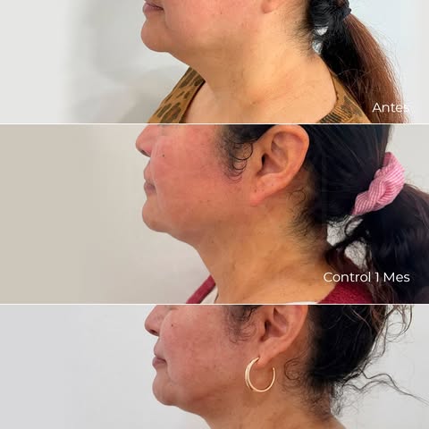 👆A veces la única solución no es un lifting con cirugía, cortes y recuperación larga para la flacid