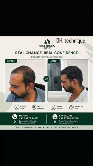 DHI advanced technique for Hairtranspant at Facethetic clinic Bandra West Mumbai and Frazer town Ben