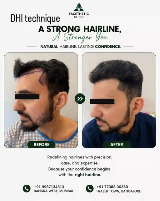 DHI advanced technique #hairtransplant at Mumbai and Bengaluru