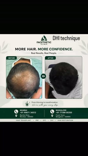 DHI advanced technique for Hairtranspant at Facethetic clinic Bandra West,Mumbai and Frazer town,Ben