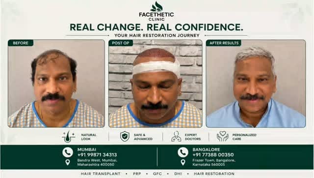 DHI advanced Direct hair implantation technique