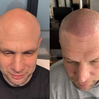 This hair didn’t grow back ... we TATTOOED
IT!

A Lifechanging hair loss solution 💪🏽✨
Natural resu