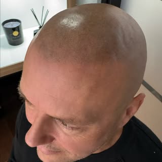 SMP - Scalp Micropigmentation / Hair Tattoo

Contact me for more info 🫵🏼 

#smp #scalpmicropigment