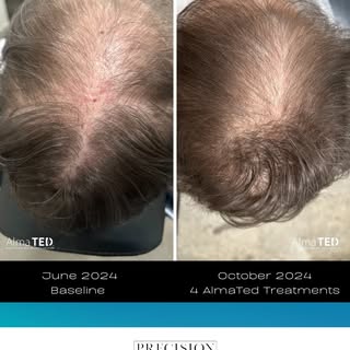 What a difference 4 months makes with the AlmaTed!

The most advanced non-invasive hair restoration 