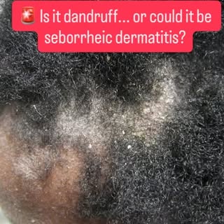 If you’re experiencing:
✨ Persistent flakes
✨ An itchy scalp
✨ Redness or irritation
✨ Oily, yellowi