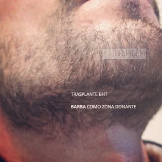 BARBA 🧔🏻 como zona donante de unidades foliculares & Recupera tu juventud

Fig 1. Zona antes
Fig 2