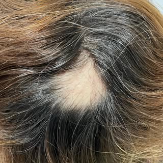 ⚠️ Placa “sin pelo”. Es un motivo de consulta bastante frecuente

📷 En la primera imagen la clínica