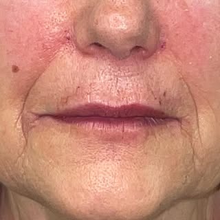 Labios 👄 “que no se noten”

Hidratación y perfilado con infiltración de baja concentración

Es muy 