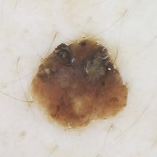 Revisa tus ⚠️ lunares, verrugas, angiomas y seborricas

La clave del éxito es el diagnóstico precoz 