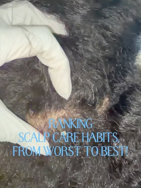 Some of the habits we have towards our scalp are the reasons why it stays itchy, inflamed and clogge