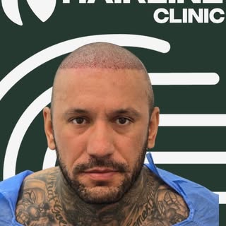 Thinking about going overseas for a hair transplant? Or know someone who is?

A great hair transplan