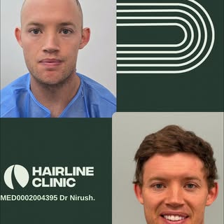 12 Months | 3,031 Grafts | 6,827 Hairs | Ratio 2.25

Dr Nirush Rameswaran
Medical Practitioner (Gene