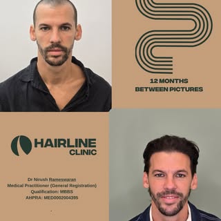 @doctor_noosh 12 months post Hair transplant 

Dr Nirush Rameswaran
Medical Practitioner (General Re