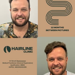 12 months post procedure, 5200 grafts implanted across frontal / mid scalp & crown. 

Dr Nirush Rame