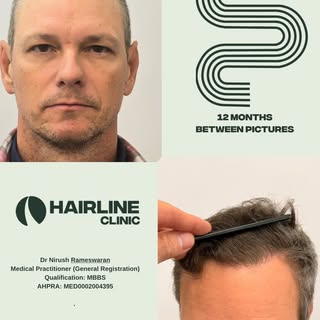 @doctor_noosh - 12 months post hair transplant 5900 Grafts implanted and extracted over 2 consecutiv