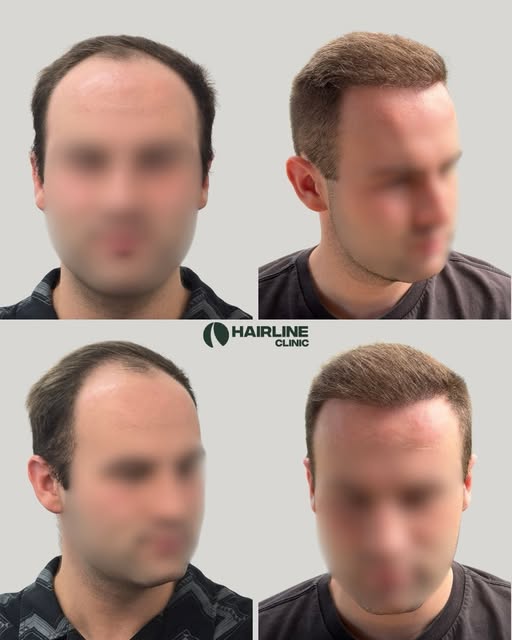 @doctor_noosh 6 months post Hair transplant 

Dr Nirush Rameswaran
Medical Practitioner (General Reg