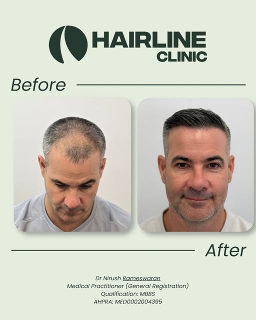 12 month post procedure

3175 grafts - 7302 hairs

Fue - Hybrid punch WAW 0.85

Multi and single imp