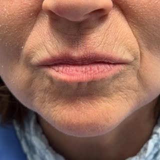 ✨ Before & After Laser Treatment for Vascular Pigmentation ✨

Swipe to see the before pictures! A fe