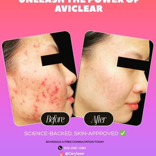 🚨 Real Results. Real Confidence.
Swipe to see what AviClear can do for your skin!

Our science-back