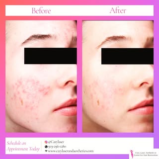 ✨ Real Results. Real Confidence. ✨

Say goodbye to stubborn acne and hello to smoother, clearer skin
