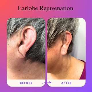 ✨ Earlobe Rejuvenation – The Subtle Touch That Makes a Big Difference ✨
Say goodbye to stretched, sa