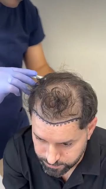 Warum wird die Haarlinie im Zickzack gezeichnet?

Unser Patient ist selbst Friseur – er weiß, wie Ha