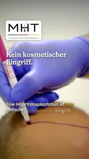 Eine Haartransplantation ist kein einfacher kosmetischer Eingriff – sie ist eine Gewebetransplantati