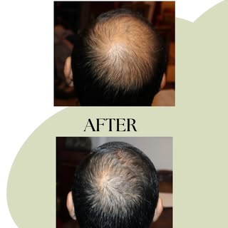 Amazing results✨ #hairgrowthjourney #hairloss #fyp