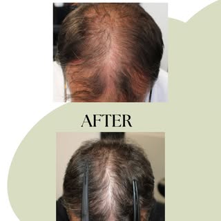 Before and after results ✨✨✨ #hairloss #growth #hairgrowth