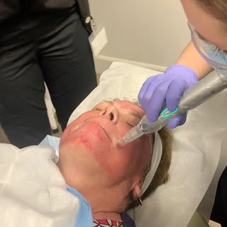 Dr. Henley performing micro needling with the newest device here @lanoimedicalgroup The Eclipse Micr
