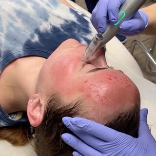 Dr. Henley and her lovely assistant  Daniella performing another micro needling treatment today. The