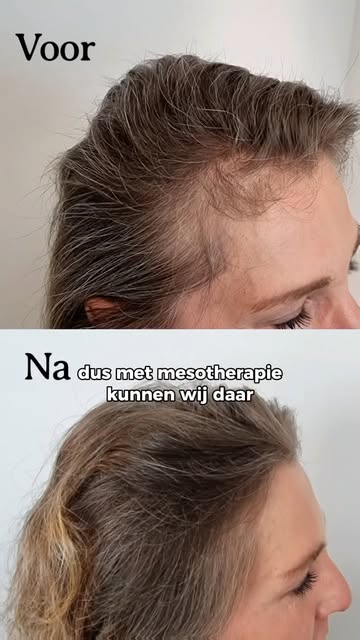 De blaadjes vallen… maar liever niet te veel haren erbij. 🍂😅

In de herfst merken heel wat mensen 