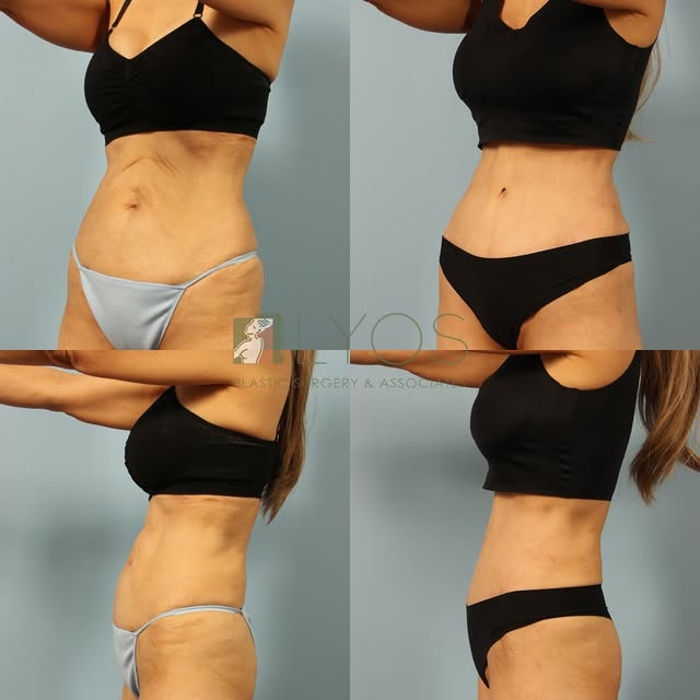 An amazing 7 month Tummy Tuck and hernia repair result performed by Dr. Lyos✨

Interested in this pr