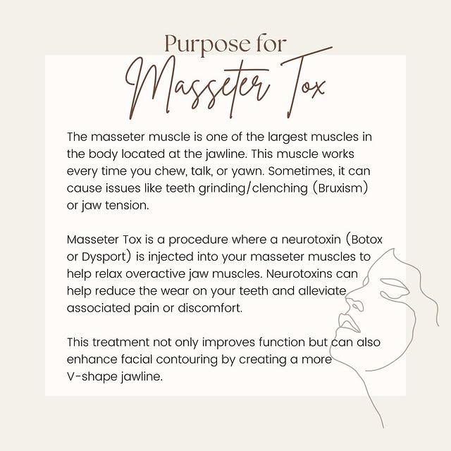 Masseter Tox is a procedure where a neurotoxin (Botox or Dysport) is injected into your masseter mus